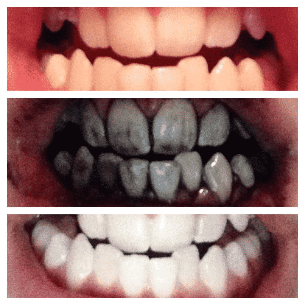 Отбеливание зубов углем отзывы фото ополаскиватель детский